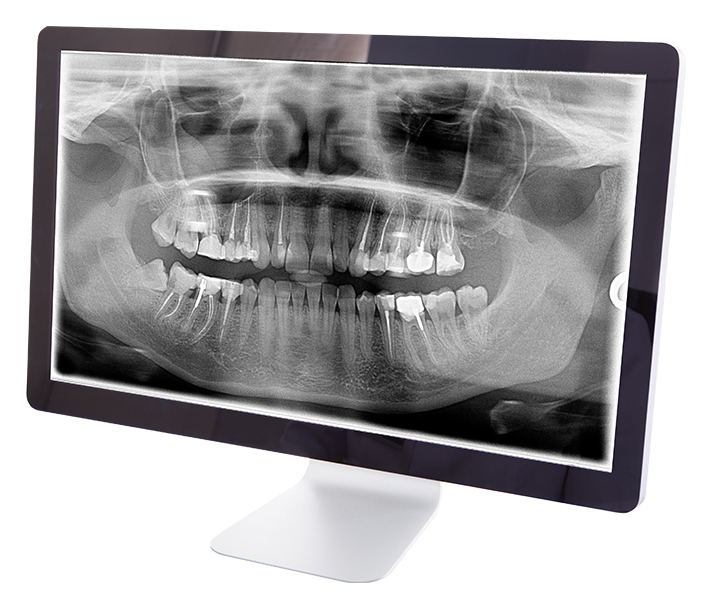 digital x-rays con computer